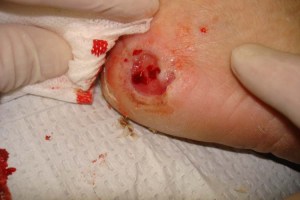 Neuropathic_heel_ulcer