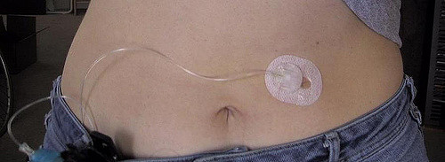 insulin pump